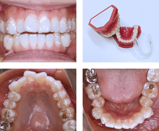 マウスピース型矯正装置（インビザライン）｜明石の矯正歯科は